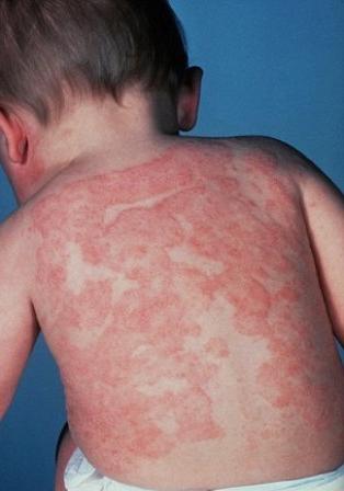 De meest voorkomende huidziekten bij een kind