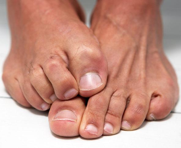 Een ongezonde schimmel op de nagels van de voeten: behandeling met folkremedies